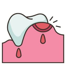 Gingivitis